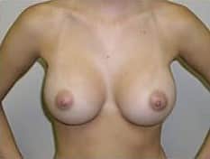 After Image: Breast Augmentation - front
