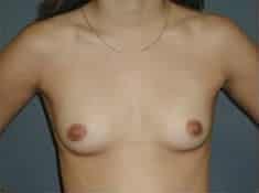 Before Image: Breast Augmentation - front