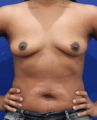 Before Image: Breast Augmentation - front