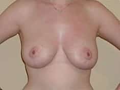 After Image: Breast Lift - front