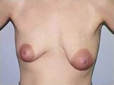 Before Image: Breast Lift - front