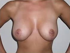 After Image: Breast Lift - front