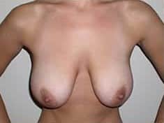 Before Image: Breast Lift - front
