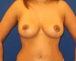 After Image: Breast Lift - front