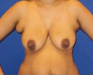 Before Image: Breast Lift - front