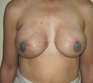 After Image: Silicone Implant Reconstruction - front