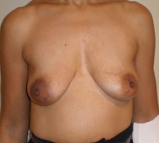 Before Image: Silicone Implant Reconstruction - front