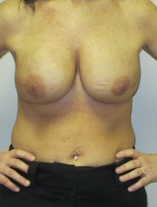 After Image: Saline Implant Reconstruction - front
