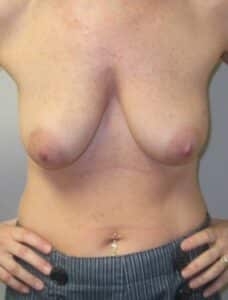 Before Image: Saline Implant Reconstruction