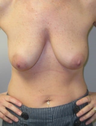 Before Image: Saline Implant Reconstruction - front
