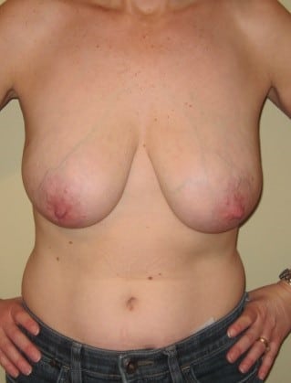 Before Image: Saline Implant Reconstruction - front