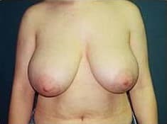 Before Image: Breast Reduction - front