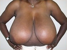 Before Image: Breast Reduction - front