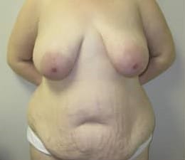 Before Image: Mommy Makeover - front