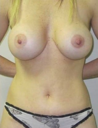 After Image: Mommy Makeover - front