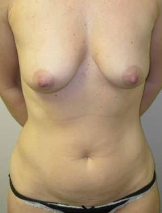 Before Image: Mommy Makeover - front