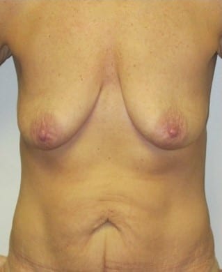 Before Image: Mommy Makeover - front