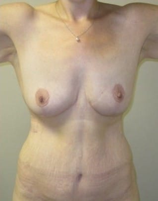 After Image: Post-Bariatric Body Contouring - front