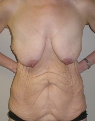 Before Image: Post-Bariatric Body Contouring - front