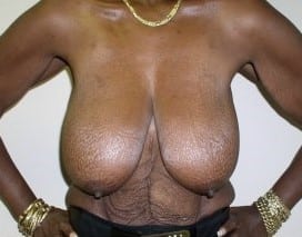 Before Image: Post-Bariatric Body Contouring - front
