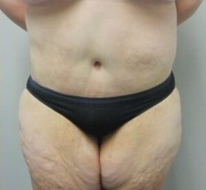 After Image: Post-Bariatric Body Contouring