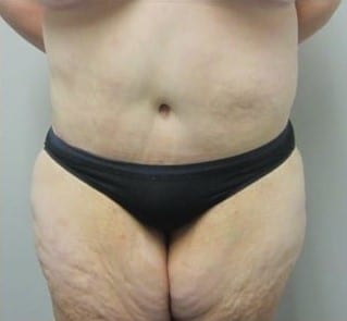 After Image: Post-Bariatric Body Contouring - front