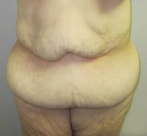 Before Image: Post-Bariatric Body Contouring