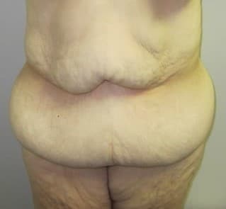 Before Image: Post-Bariatric Body Contouring - front
