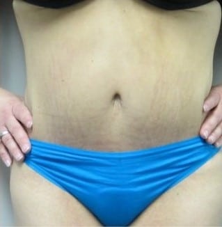 After Image: Post-Bariatric Body Contouring - front