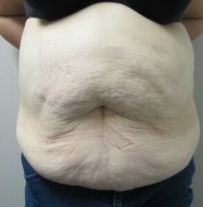Before Image: Post-Bariatric Body Contouring