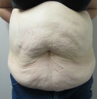 Before Image: Post-Bariatric Body Contouring - front