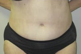 After Image: Abdominoplasty - front