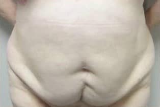 Before Image: Abdominoplasty - front