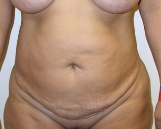 Before Image: Abdominoplasty - front