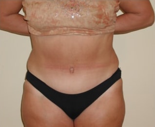 After Image: Abdominoplasty - front