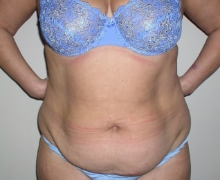 Before Image: Abdominoplasty - front