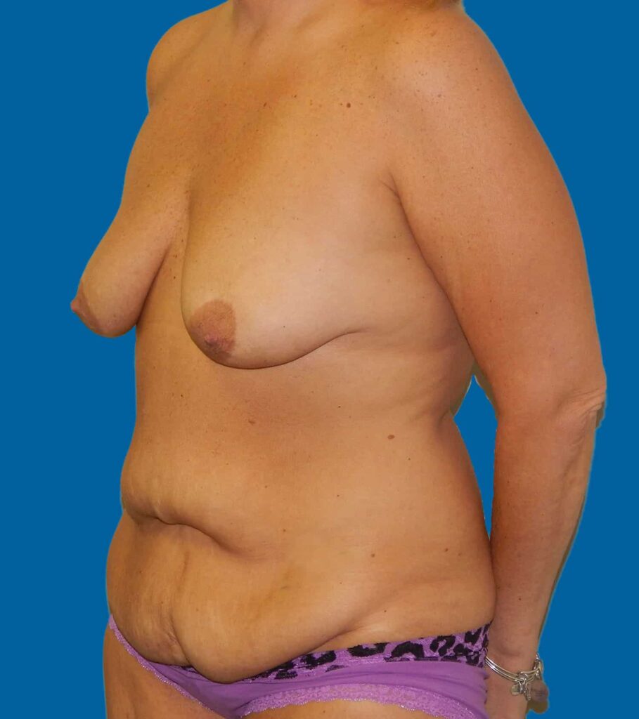 Before Image: Breast Augmentation with Lift - left-front-oblique
