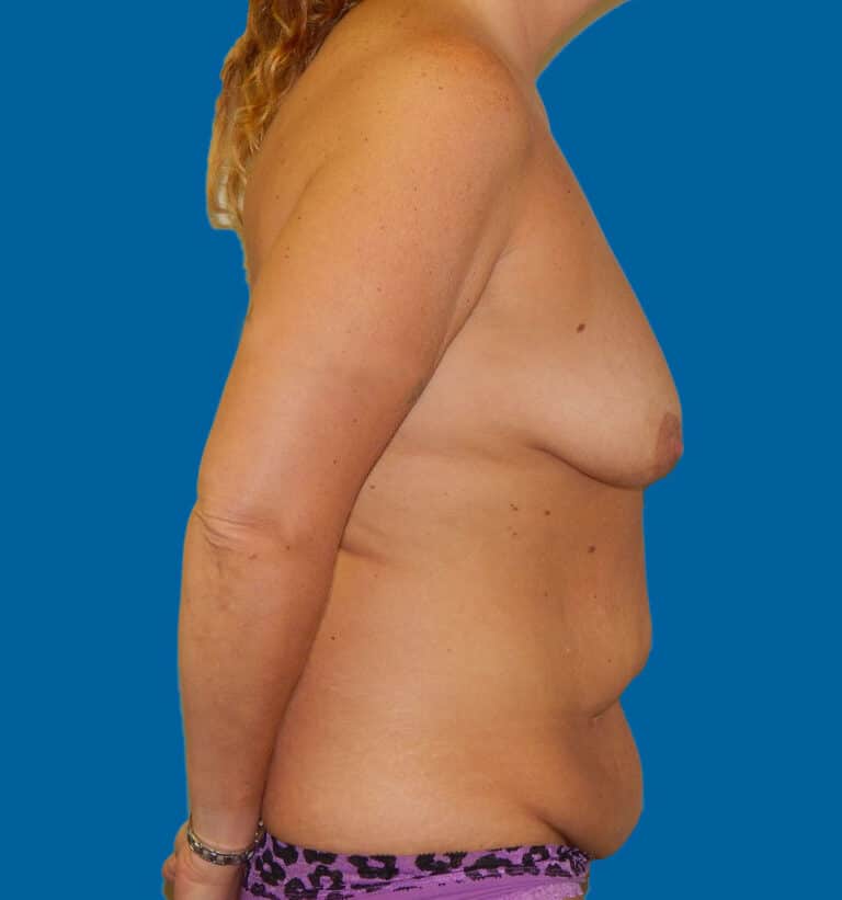 Before Image: Breast Augmentation - right-side