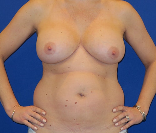 Before Image: Mommy Makeover - front