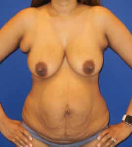 Before Image: Mommy Makeover