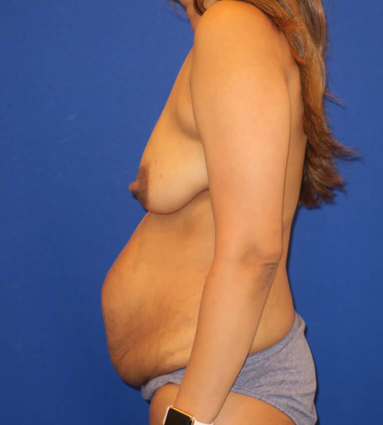Before Image: Mommy Makeover - left-side