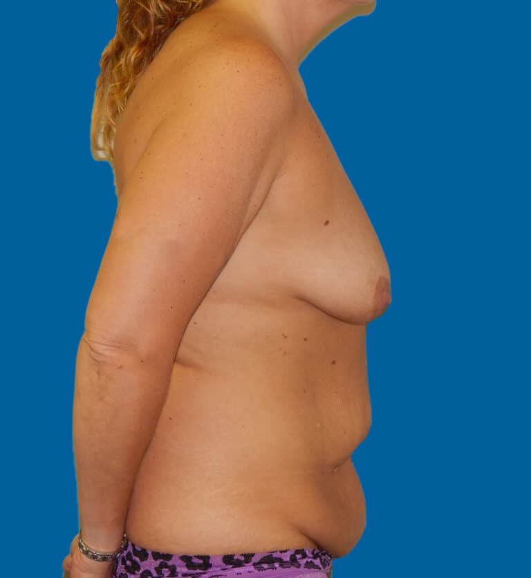 Before Image: Mommy Makeover - right-side