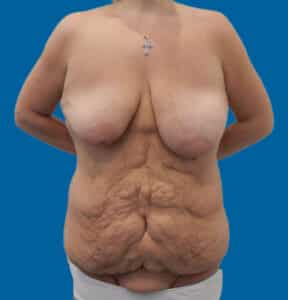 Before Image: Mommy Makeover