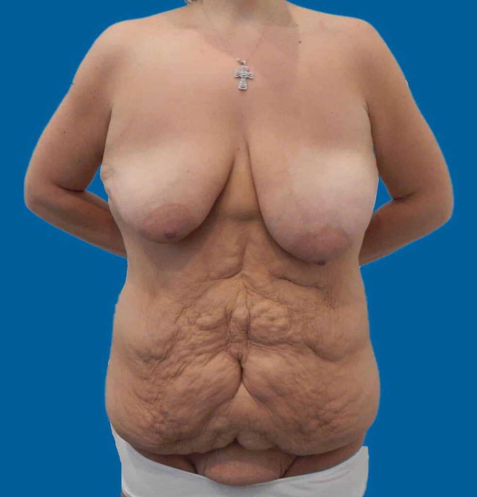 Before Image: Mommy Makeover - front
