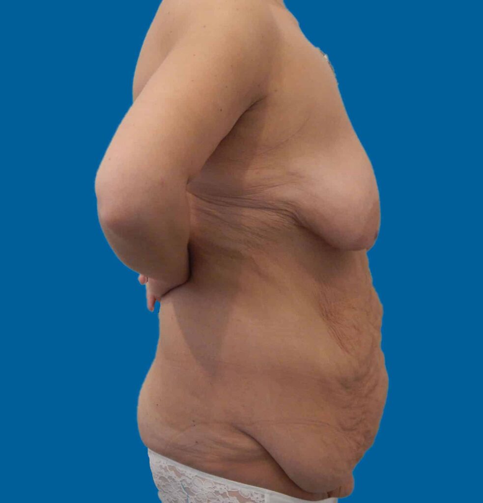 Before Image: Mommy Makeover - right-side
