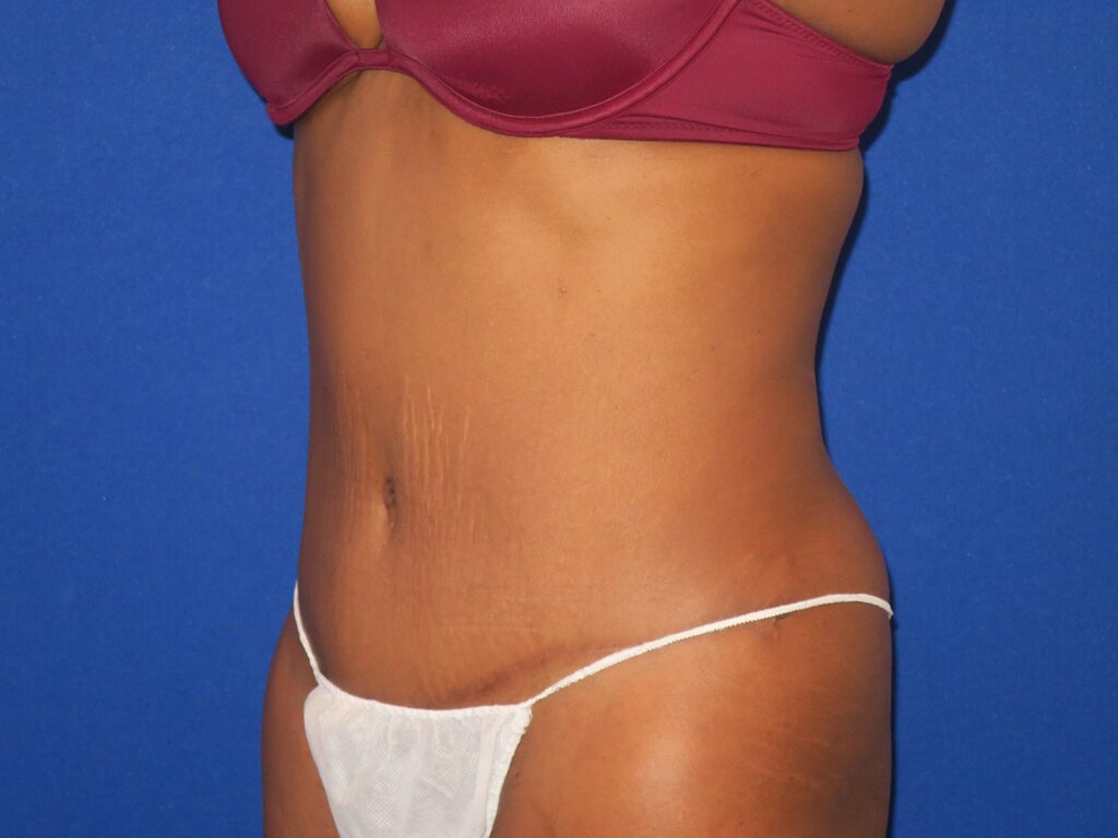 After Image: Abdominoplasty - left-front-oblique