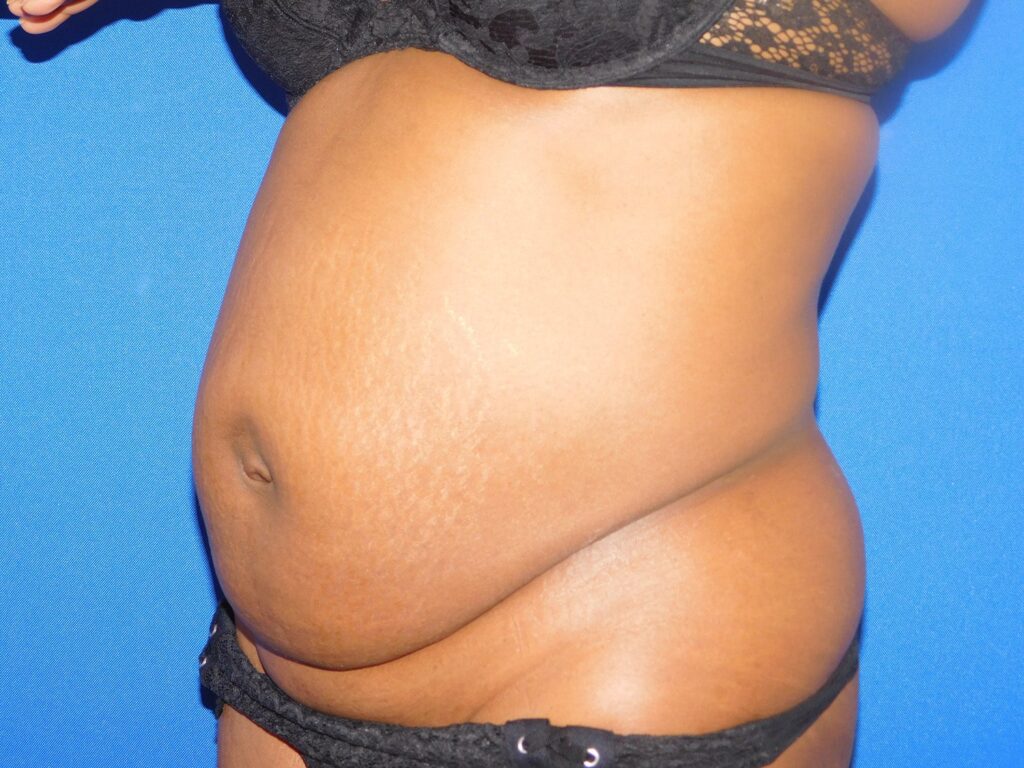 Before Image: Abdominoplasty - left-front-oblique