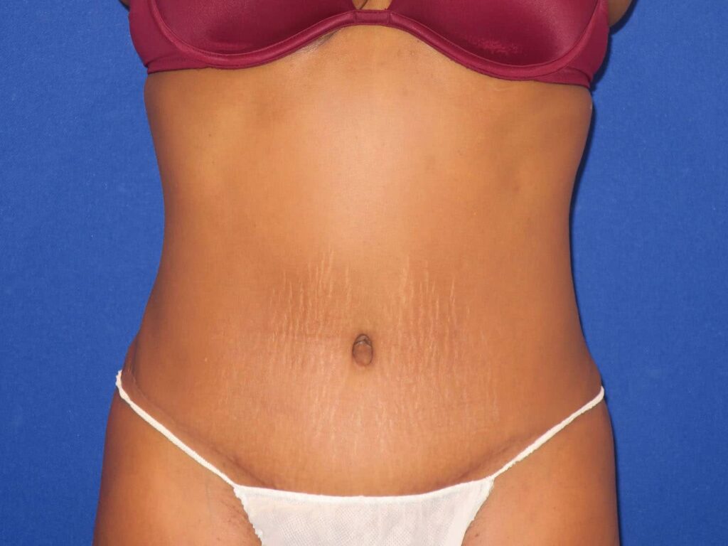 After Image: Abdominoplasty - front