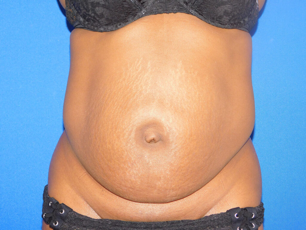 Before Image: Abdominoplasty - front
