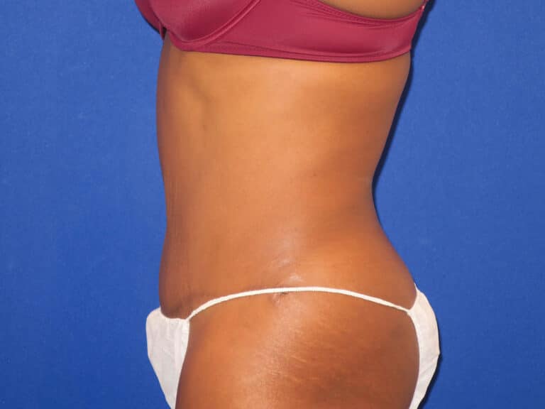After Image: Abdominoplasty - left-side